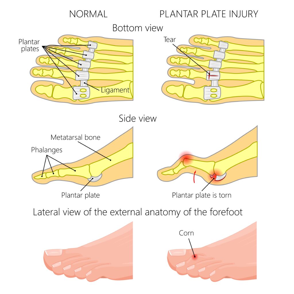 Diagram comparing the anatomy of a normal forefoot with one affected by a plantar plate injury. It shows the bottom and side views of the foot, highlighting the location and tear in the plantar plate, and includes an external view indicating the presence of a corn on the injured foot.