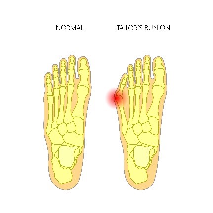 A diagram showing the location of tailor's bunion, as a bony lump at the side of your fifth toe joint.