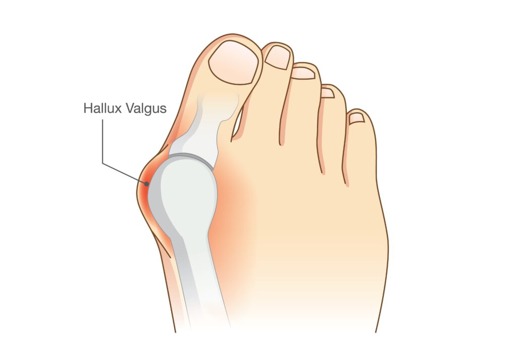 A diagram showing the location of hallux valgus