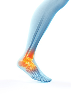 Diagram displaying osteoarthritis of the ankle