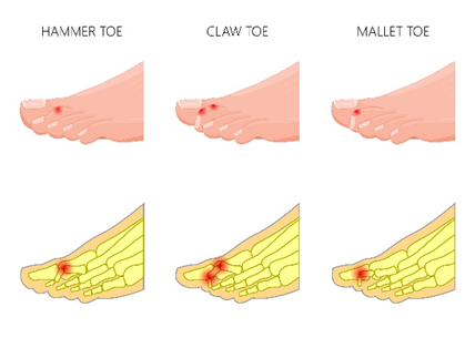 Diagram illustrating hammer toe, claw toe and mallet toe