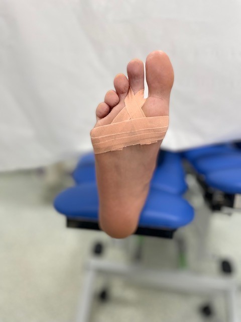 An example of plantar plate tear strapping